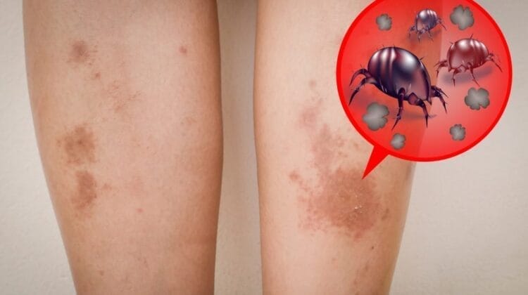 لدغات عث الغبار: الأعراض والعلاج