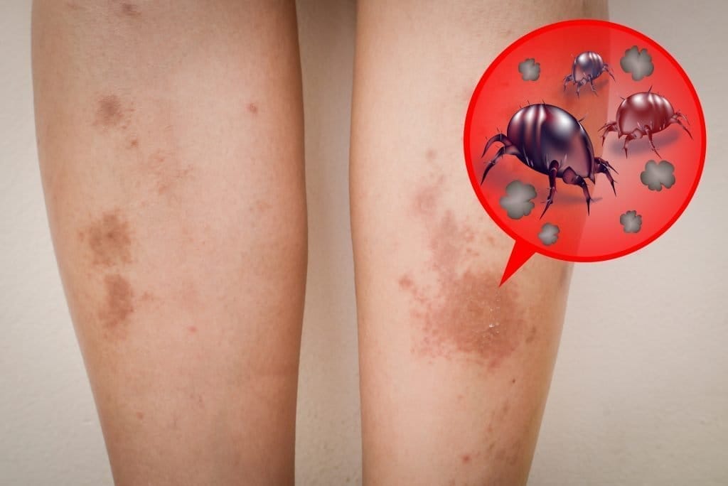 لدغات عث الغبار: الأعراض والعلاج