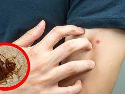 لدغة بق الفراش أكثر من البعوض